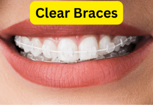 clear braces in Newark CA