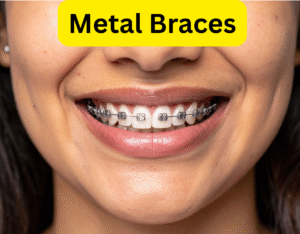 Braces in Newark